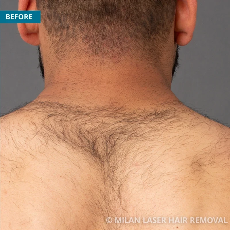 Men's Before & After Photos of Laser Hair Removal | Milan Laser in Eugene,  OR